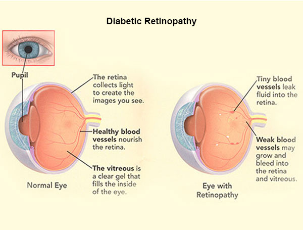Diabetic retinopathy