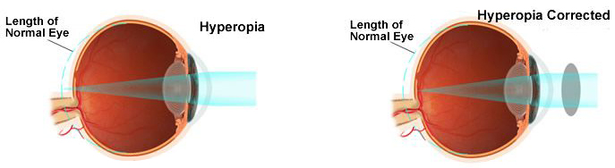 Long-Sightedness (Hypermetropia)