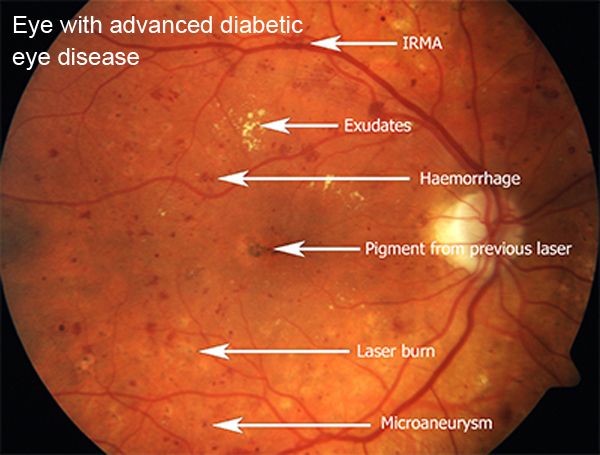 eye with advanced diabetic eye diseas