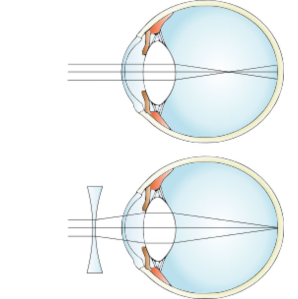 myopia lens