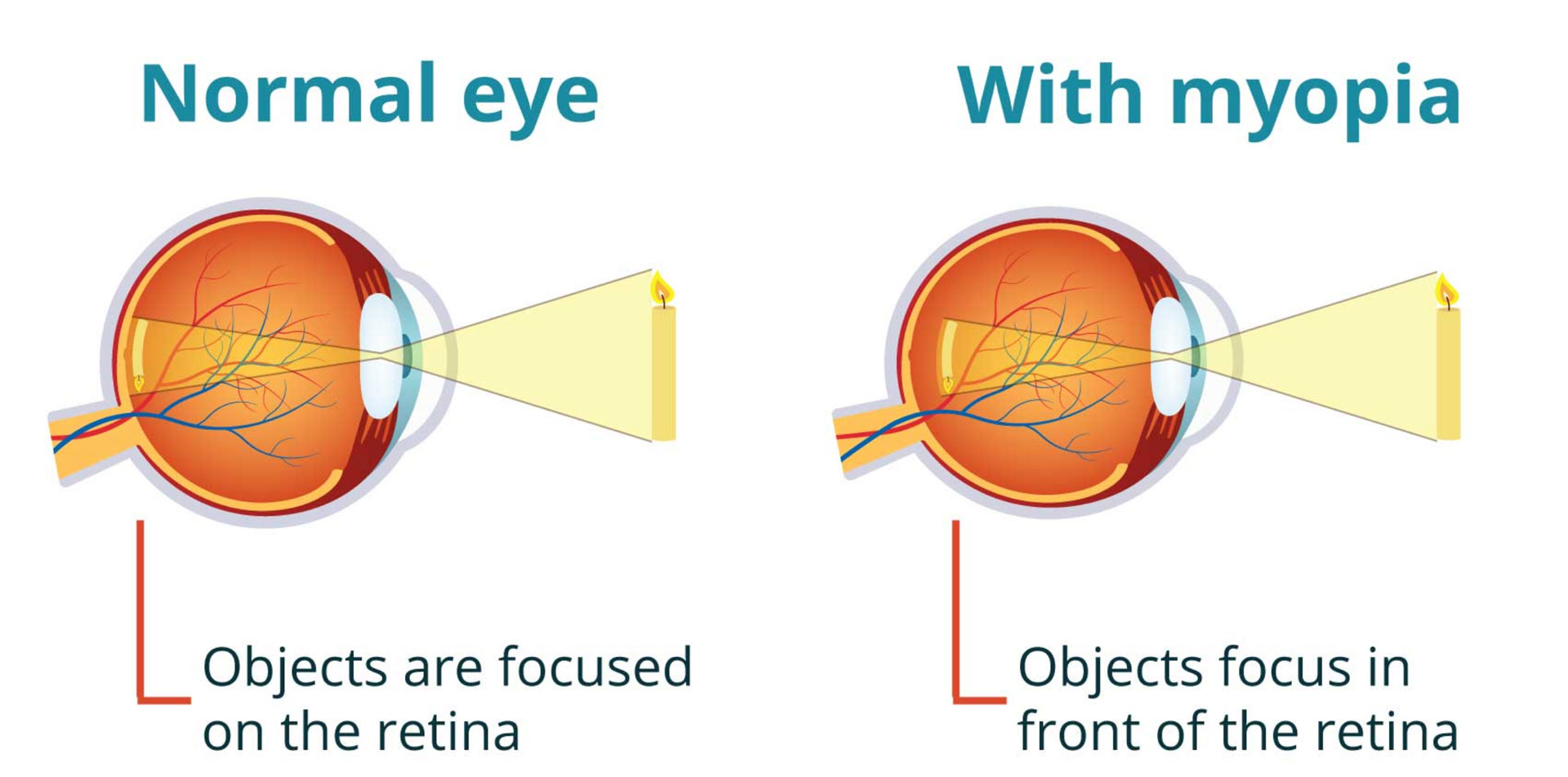 eye image with and without myopia